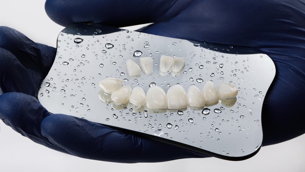 Veneers